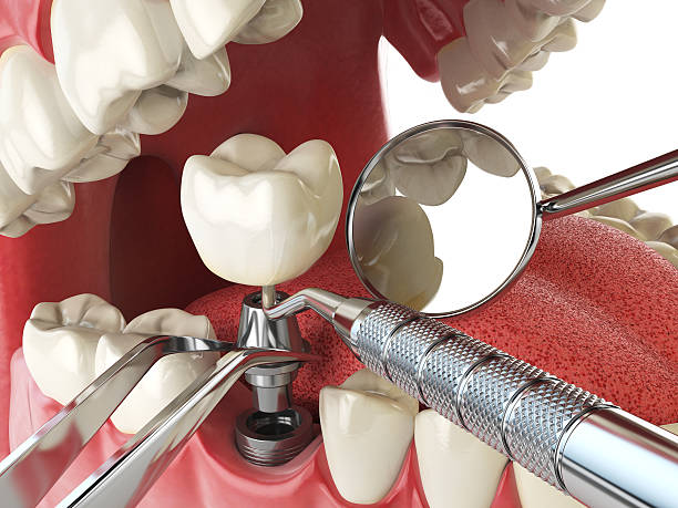 Best Dental Abscess Treatment in Nanuet, NY